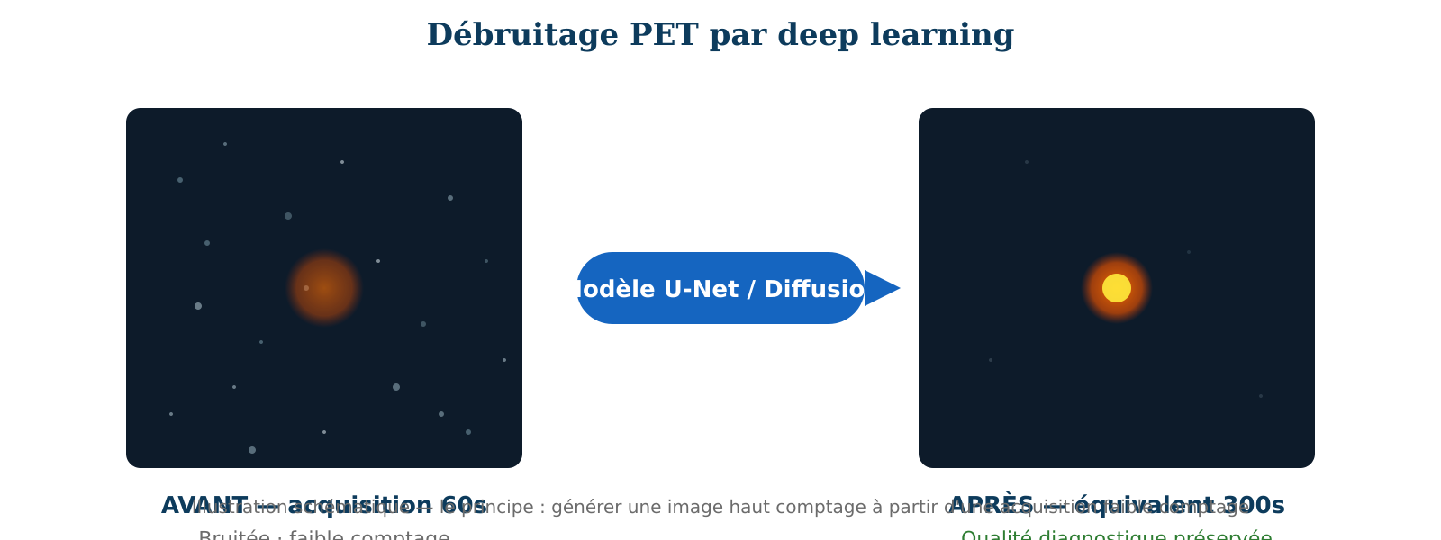 Figure 2 &middot; Principe du d&eacute;bruitage PET par deep learning. Une acquisition courte (ou &agrave; faible dose) produit une image bruit&eacute;e (&agrave; gauche). Un r&eacute;seau de neurones entra&icirc;n&eacute; sur des paires d'images bas/haut comptage g&eacute;n&egrave;re une image restaur&eacute;e (&agrave; droite) de qualit&eacute; diagnostique comparable &agrave; une acquisition standard.