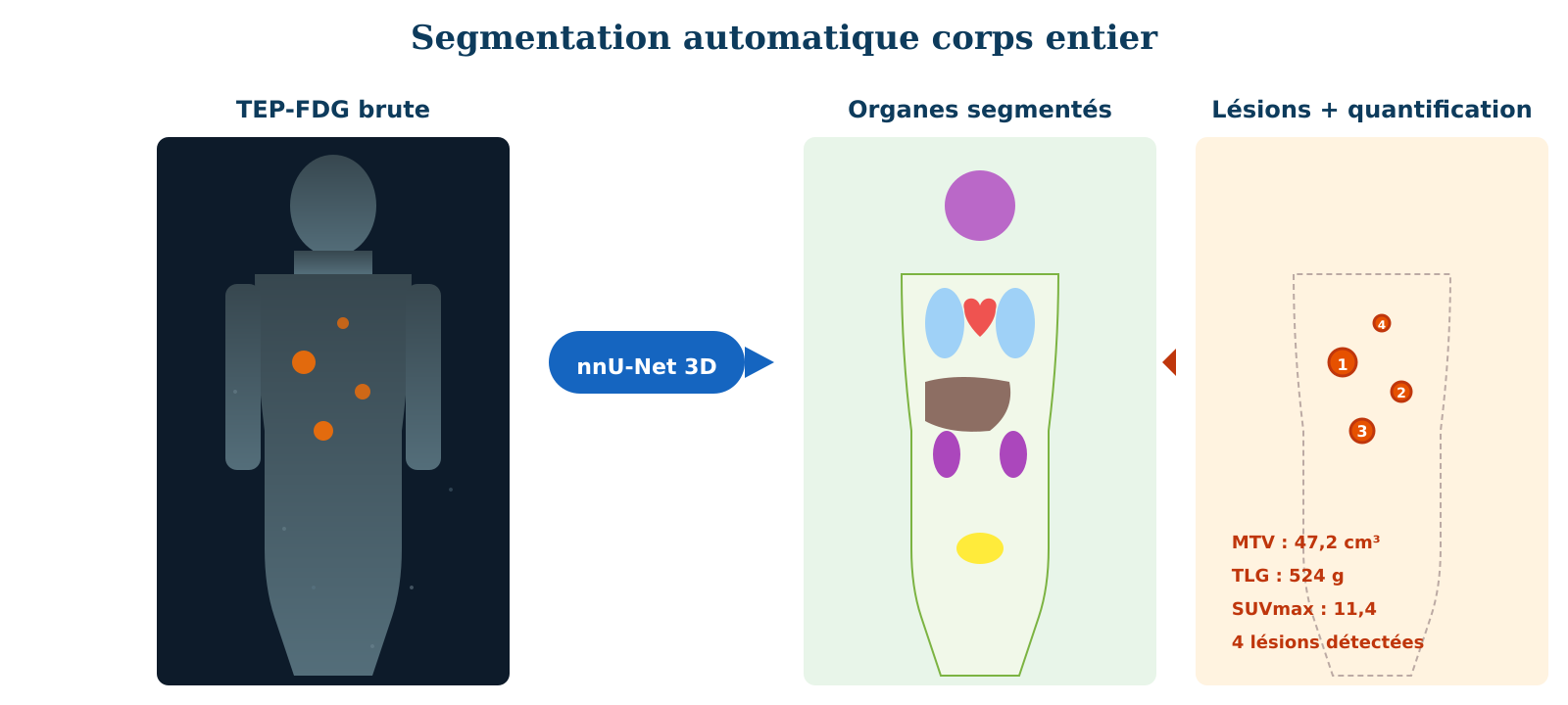 Figure 3 &middot; De l'image brute &agrave; la quantification automatique. Un r&eacute;seau nnU-Net 3D (ou un foundation model type TotalSegmentator, MOOSE, SegAnyPET) segmente en quelques secondes les organes puis les l&eacute;sions tumorales, et calcule instantan&eacute;ment les param&egrave;tres quantitatifs (MTV, TLG, SUVmax). Ce qui prenait 45 &agrave; 90 minutes en d&eacute;limitation manuelle est d&eacute;sormais r&eacute;alis&eacute; en moins d'une minute.